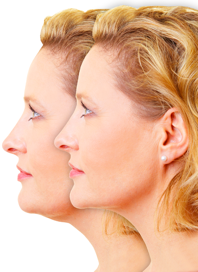 Turkey Neck Surgery - Premium neck lift and rejuvenation results in Istanbul, Turkey